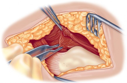 Illustration 30 for Direct Lateral Hip: Optimize Exposure with Sharp Curved Hohmann