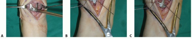 Illustration 53 for Mastering Midfoot Arthrodesis: Protect the Deep Neurovascular Bundle