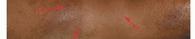 Illustration 9 for Advanced Distal Femoral Resections: Limb-Sparing Outcomes & Techniques