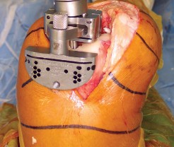 صورة طبية: استبدال مفصل الركبة بالحد الأدنى من التدخل الجراحي: ألم أقل وتعافٍ أسرع مع النهج شبه الرضفي الإنسي