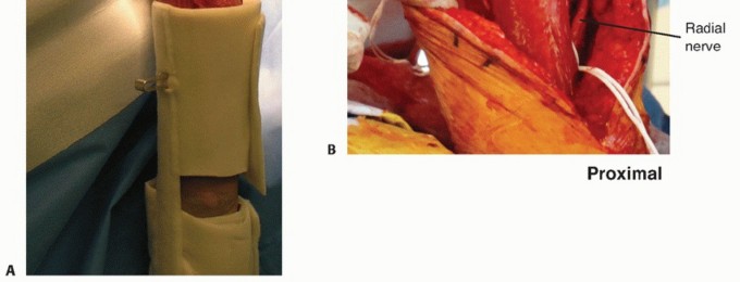 Illustration 15 for Surgical Approaches to Shoulder & Elbow: Pearls and Pitfalls