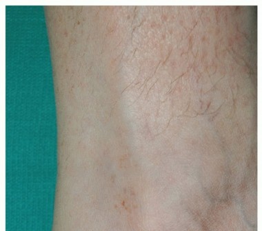 Insertional Achilles Tendinopathy: Causes, Symptoms & Relief