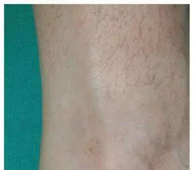 صورة توضيحية لـ التهاب وتر أخيل الإدخالي: دليلك الشامل لراحة قدميك مع الأستاذ الدكتور محمد هطيف