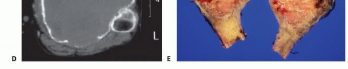Illustration 5 for Tackling Complex Tumors of the Proximal Tibia: Limb-Sparing Solutions