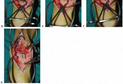 Illustration 40 for Unlock Healing: Medial Malleolar Osteotomy for Talus OLT Allografts