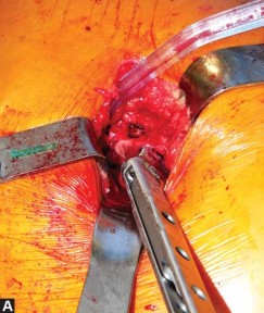 Illustration 48 for Exploring the Ambulatory Surgical Setting for Total Hip Replacement