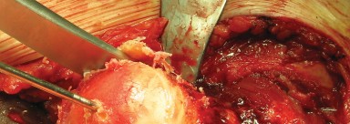 Illustration 41 for Figure Hip Resurfacing: Who Benefits and Who Should Avoid It?