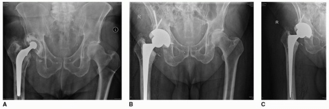 Illustration 58 for Cement in Cement Revision: Simplifying Complex Hip Revisions