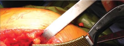 Illustration 29 for Unlock better THA: The technique of short stem for less invasiveness