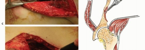 Illustration 33 for Pelvic Metastasis Surgery: A Component of the Utilitarian Approach