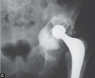 Illustration 35 for Optimizing Acetabular Component Cementation for Superior Outcomes