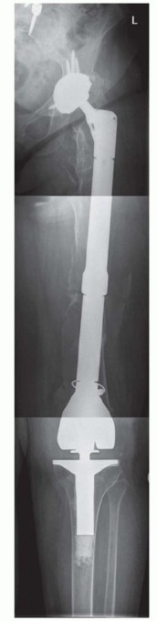 Illustration 5 for Limb Salvage: New Advances in Proximal Femoral Replacement