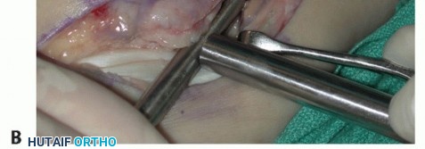 Illustration 37 for Beyond Primary Repair: Solutions for Peroneal Tendon Subluxation