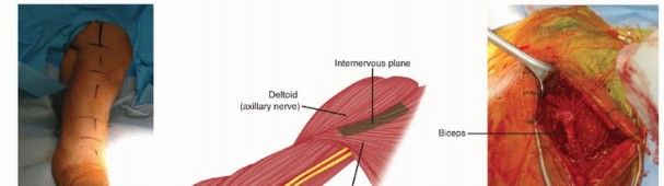 Illustration 9 for Surgical Approaches to Shoulder & Elbow: Pearls and Pitfalls