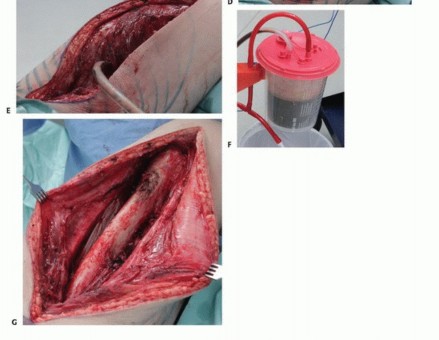 Illustration 25 for Limb-Sparing Quadriceps Resection: Superficial Femoral Artery