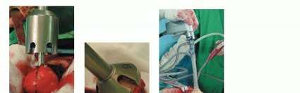 Illustration 9 for Hip Resurfacing: The Bone-Sparing Solution around the Femoral Head