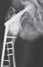 Illustration 14 for Advanced Arthroplasty for Malignant Lesions: Reclaim Your Mobility