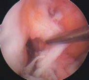 Illustration 38 for Optimizing Single-Bundle Anterior Cruciate Ligament Repair