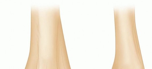 Illustration of fixation of capitellar fractures - Dr. Mohammed Hutaif