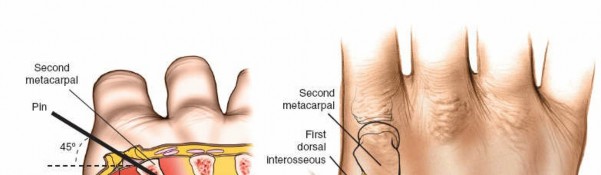 Illustration 9 for Expert Guide: Ulna and Wrist External Fixation Pin Placement
