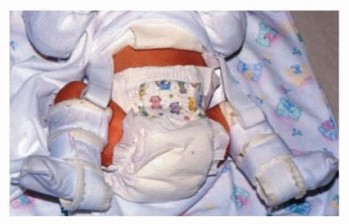 Illustration 8 for Mastering Anterior Open Reduction for Developmentally Dislocated Hip