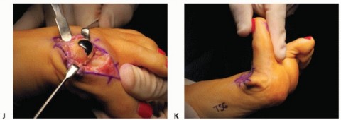 Illustration 50 for End Articular Cartilage Loss: Arthrosurface HemiCAP Resurfacing