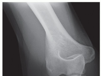 Illustration 7 for Radial Head & Neck Fractures: Mastering ORIF for Best Results