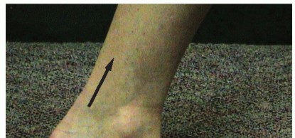 Stop Calcaneal Malunion Pain: Lateral Wall Exostectomy Revealed