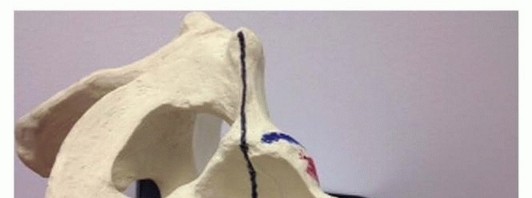 Illustration 10 for Total Hip Arthroplasty: Journey to Preventing Complications