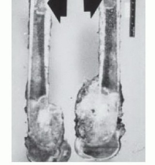 Illustration 7 for Precision Biopsy of Musculoskeletal Tumors for Accurate Diagnosis