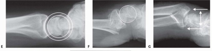 Illustration 12 for Fragment-Specific Fixation: Restore Carpal Facet Horizon