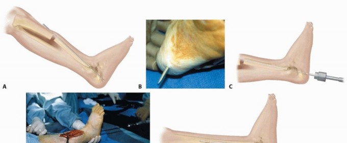 Illustration 8 for Williams Rod: Achieve Stability for Pseudarthrosis within the Tibia