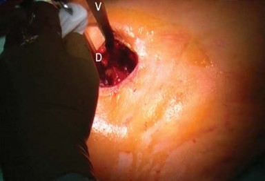 Illustration 16 for Mastering the Anterolateral Approach in Minimally Invasive Hip Replacement