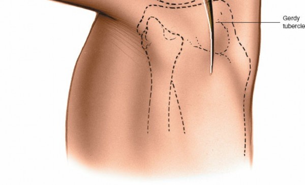 Illustration 143 for Mastering Knee Approaches: Spotlight on Superficial Medial Ligament
