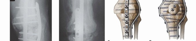 Illustration 13 for Knee Arthrodesis: A Solution for Stable Femur & Tibia Fusion