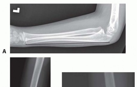 Solving Missed Monteggia: Key to the Lesser Sigmoid Notch