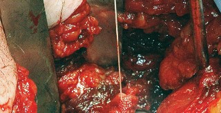 Illustration 66 for Unlock the Figure Posterior Approach to the Hip