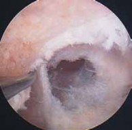 Illustration 41 for Optimizing Single-Bundle Anterior Cruciate Ligament Repair