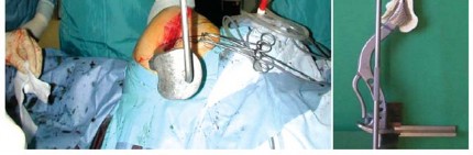 Illustration 16 for The Proxima: Why This Proximally Loading Implant Preserves Bone