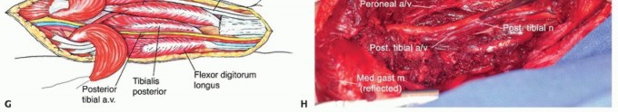 Illustration 10 for Soleus Resection for Tumors: Protecting the Heads of the Gastrocnemius