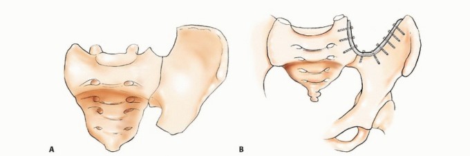 Illustration 46 for Pelvic Metastasis Surgery: A Component of the Utilitarian Approach