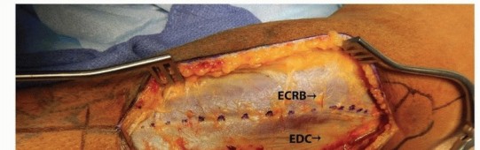 Illustration 20 for Optimal ORIF for Diaphyseal Forearm Fractures: Your Guide