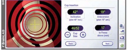 Illustration 26 for Minimizing Risks: Computer Navigation in Hip Resurfacing Arthroplasty