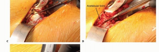 Illustration 29 for Anterior FAI Relief: Mini-Open Anterior Approach Explained