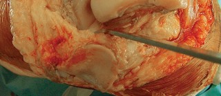 صورة طبية: مراجعة استبدال الركبة الجزئي الفاشل دليلك الشامل للعلاج الناجح في صنعاء