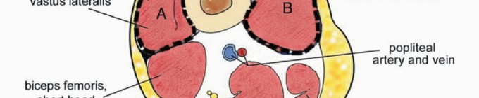 Illustration 3 for Limb-Sparing Quadriceps Resection: Superficial Femoral Artery
