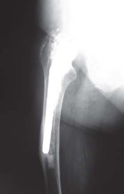 Illustration 71 for S-ROM: Inside the Technique of Modular Implant Design