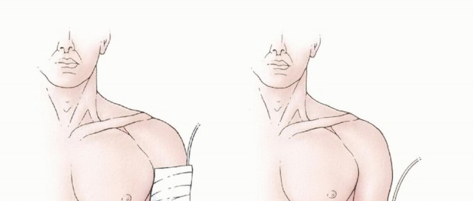 Illustration 29 for Above-Elbow & Below-Elbow Amputations: When & Why They're Needed