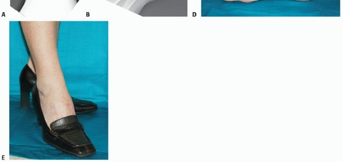 Illustration 40 for Mastering Midfoot Arthrodesis: Protect the Deep Neurovascular Bundle