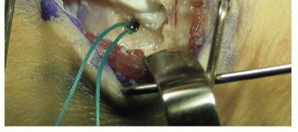 Illustration 18 for Why Anterior Tibialis Muscle Transfer Fixes Clubfoot